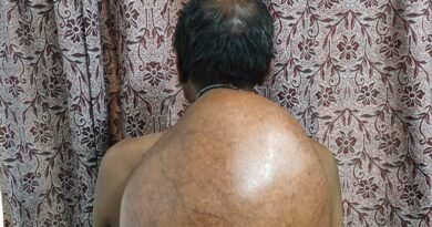 अम्बेडकर अस्पताल के सर्जरी विभाग की ऐतिहासिक उपलब्धि :10.30 किलोग्राम वजनी विशाल ट्यूमर का सफल ऑपरेशन