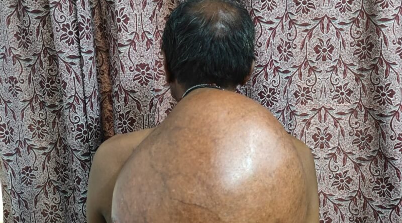 अम्बेडकर अस्पताल के सर्जरी विभाग की ऐतिहासिक उपलब्धि :10.30 किलोग्राम वजनी विशाल ट्यूमर का सफल ऑपरेशन